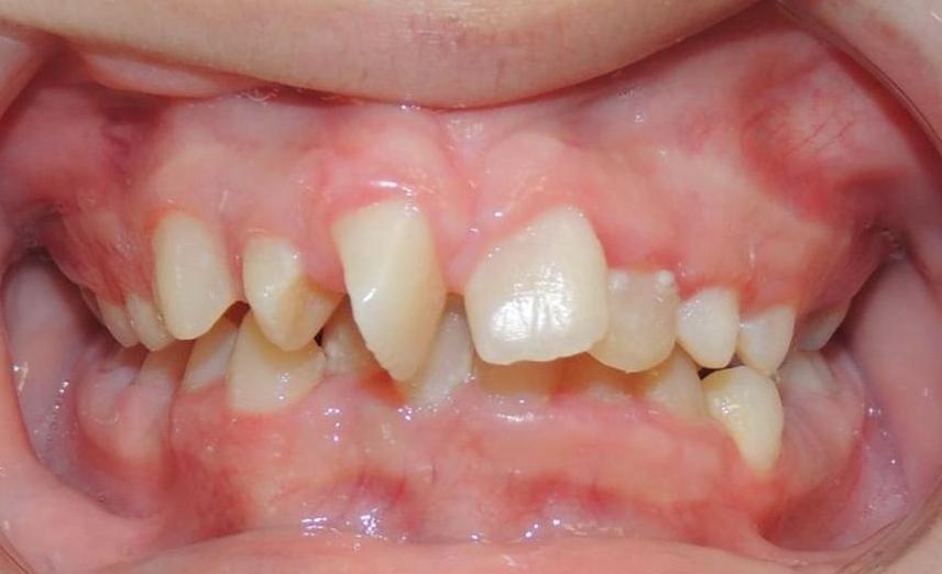 Anterior Occlusion Hithe Ortho